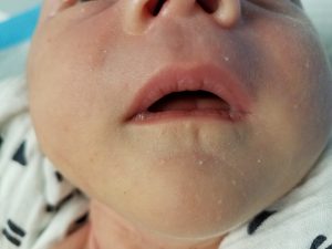 Baby with sucking blisters on upper lip